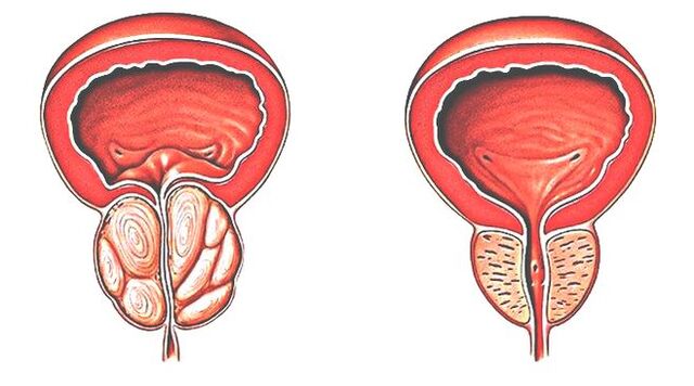 Prostatitis in normalna prostata