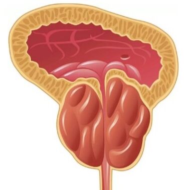 Vnetje prostate