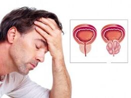 Prostatitis pri moškem