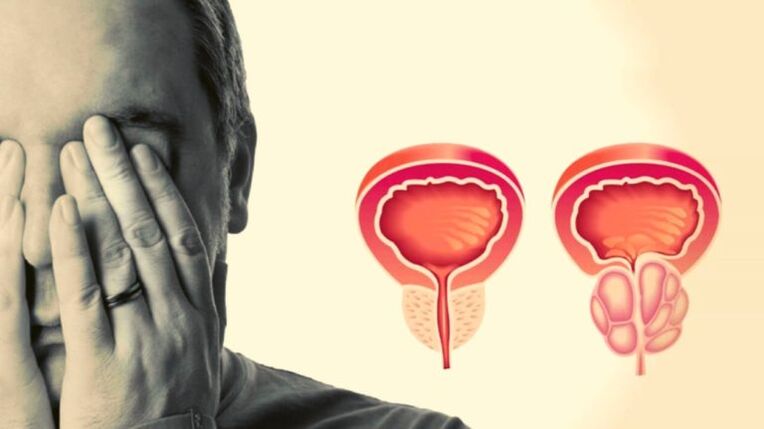 Moški ima prostatitis