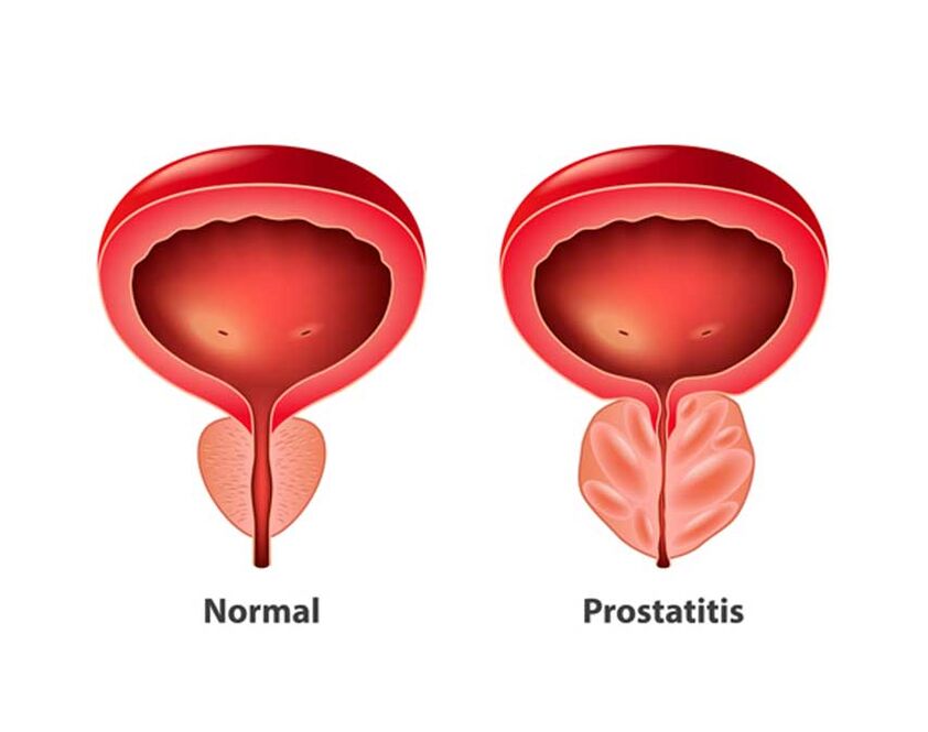 normalna in vnetna prostata