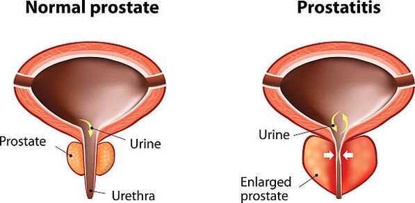 normalna in vneta prostata