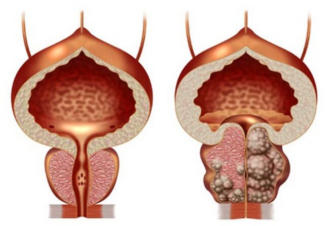 zdrava prostata in adenom prostate