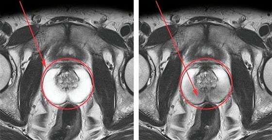 Normalna prostata (levo) in vnetje prostate s prostatitisom (desno)